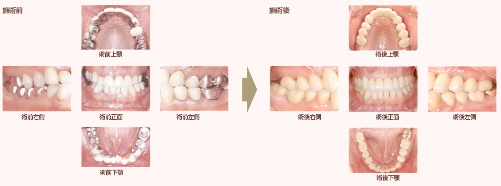 症例１～矯正治療を経て全体的に被せ物をやり直した患者さんです～