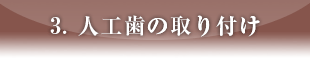 3. 人工歯の取り付け