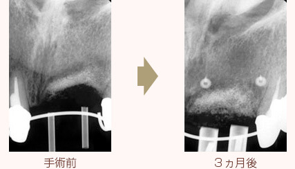 レントゲンで見る骨再生の課程